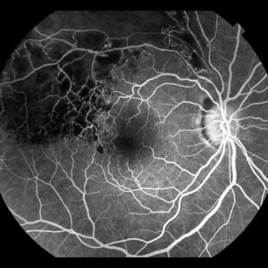 Branch Retinal Vein Occlusion"
