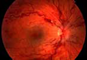 Central Retinal Vein Occlusion"